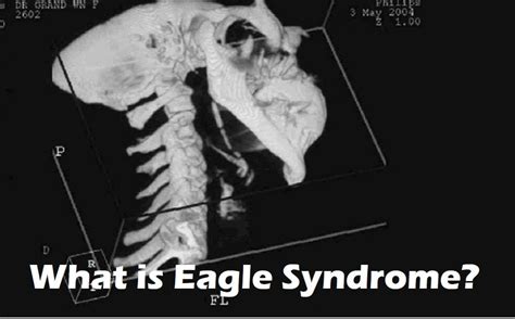 What Is Eagle Syndrome Regenexx
