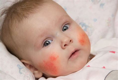 How To Get Rid Of Eczema On Face Baby Baby Eczema Treatment 5 At Home