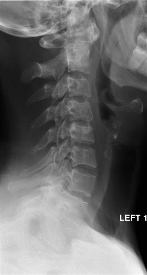 Interpreting Cervical Spine Radiographs The Bmj