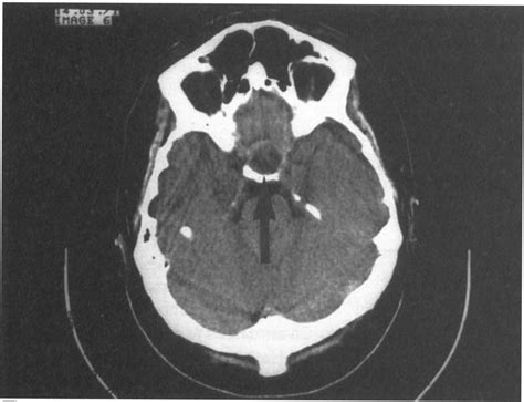 CT Scan Showing Pituitary Adenoma With Haemorrhage Arrowed Comment