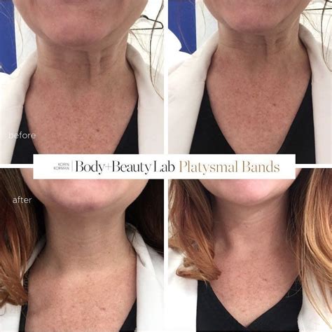Botox Before And After On Neck Before And After