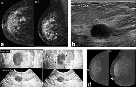 A 66 Year Old Female Presented With Right Breast Lump A Digital