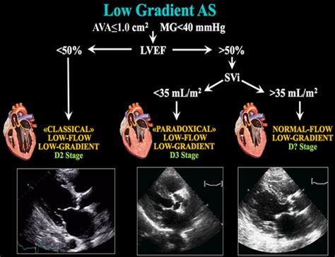 Low Gradient Severe Aortic Stenosis