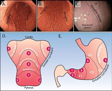 Recent Advances In The Detection And Management Of Early Gastric Cancer And Its Precursors