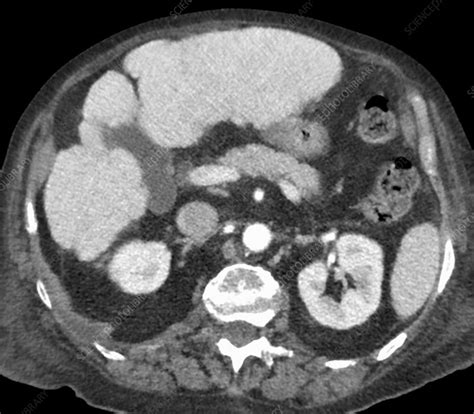 Liver Cirrhosis Ct Scan Stock Image C0213012 Science Photo Library