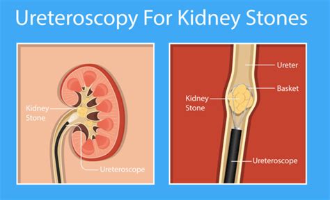 What To Expect When You Need A Kidney Stone Surgery Medanta