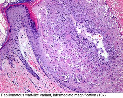 Pathology Outlines Inverted Follicular Keratosis