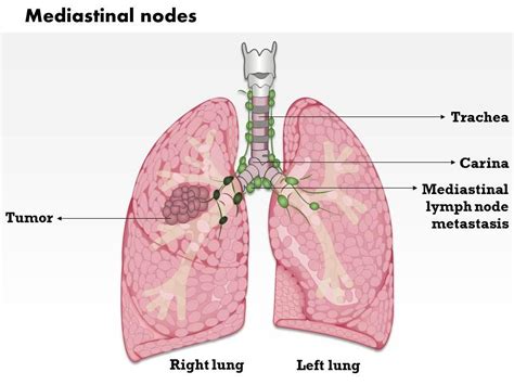 Frontiers Metastatic Patterns Of Mediastinal Lymph Nodes In 40 Off