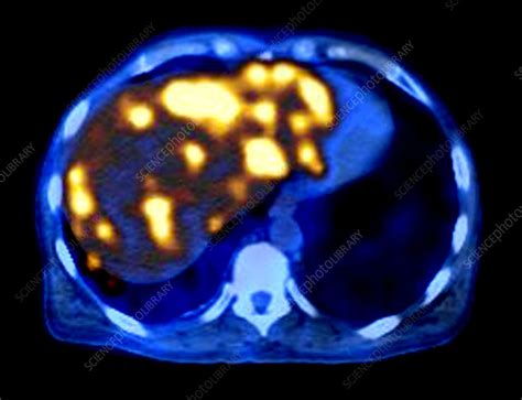 Liver Metastases Pet Ct Scan Stock Image C0174431 Science