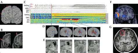 John Libbey Eurotext Epileptic Disorders Electroclinical Features