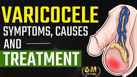 Varicocele Symptoms Causes And Treatment Varicocele Natural
