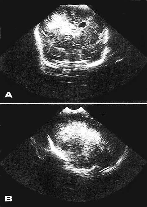 Coronal A And Right Parasagittal B Cranial Ultrasound Scans Carried