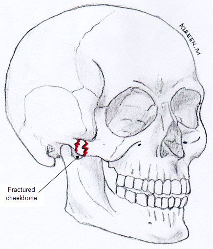 treatment  fractured cheekbone portal myhealth