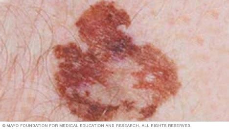 Melanoma (also called malignant melanoma) is the most serious type of skin cancer. Slide show: Melanoma pictures to help identify skin cancer ...