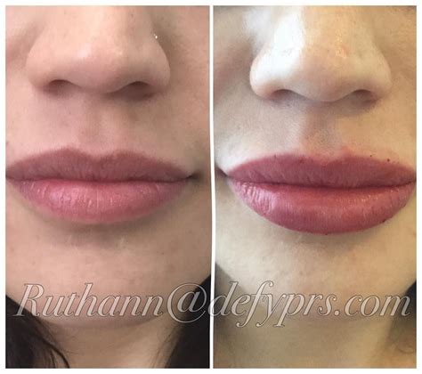 1 Syringe Of Juvederm Ultra Xc Lips Before And After Lipfillers1ml
