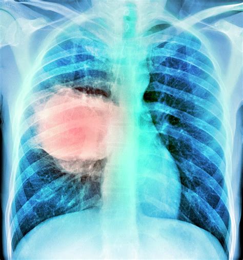 Lung Cancer Photograph By Du Cane Medical Imaging Ltd