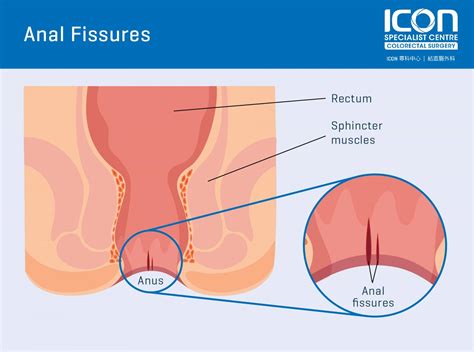 Can Anal Fissure Cause Severe Bleeding Telegraph