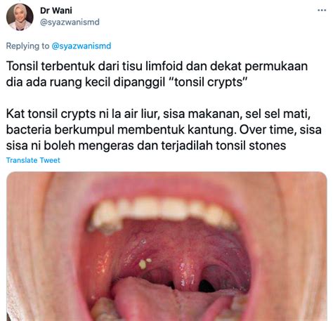 Ketulan Putih And Berbau Busuk Dalam Mulut Doktor Gigi Ini Jelaskan
