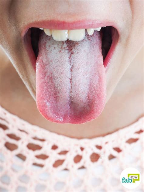 How To Get Rid Of A White Coated Tongue With Just 1 Ingredient Fab How