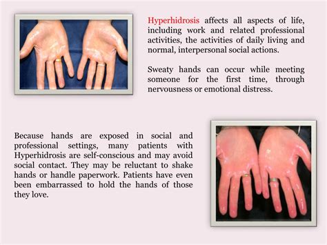 Ppt Hyperhidrosis Powerpoint Presentation Free Download Id1378664