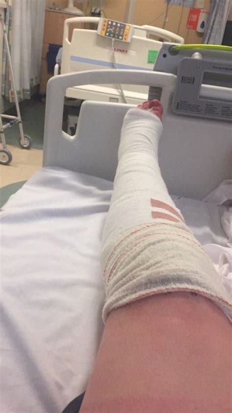 Bride Who Broke Leg In Four Places Has It Snapped Back By Bridesmaid