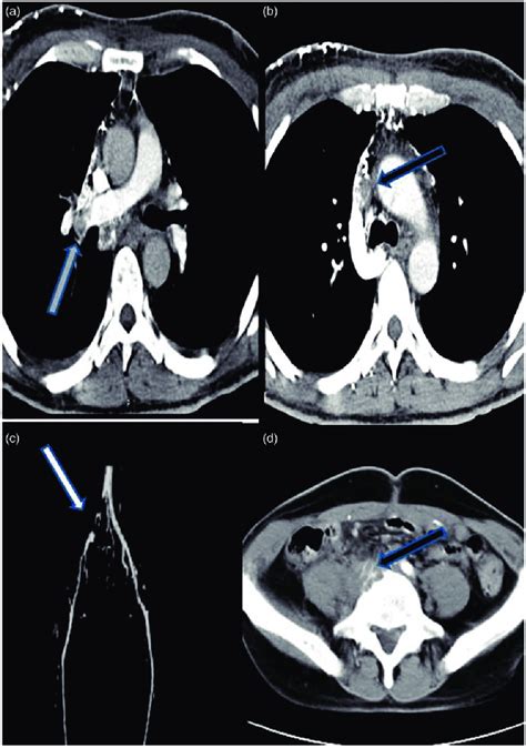 Mediastinum Ct Angiogram Showed Filling Defect Seen Along Right