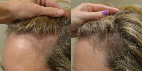 Platelet Rich Plasma Prp Before And After Photos Hair Restoration Of The South New Orleans La