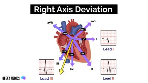 How To Read An ECG ECG Interpretation EKG Geeky Medics