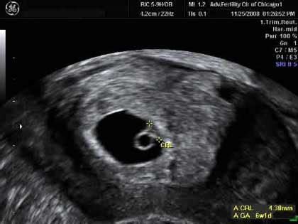 There's a bump where the heart is and another bulge where the head will be. 6 Weeks Pregnant: Symptoms, Ultrasound, Spotting and Cramping