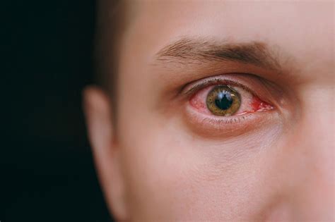 Dry Eye Syndrome And 8 Of The Top Causes Of Eye Redness Perfectlens