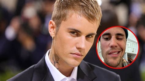 ¿qué Es El Síndrome De Ramsay Hunt Y Cómo Ha Afectado Al Rostro De Justin Bieber Tikitakas