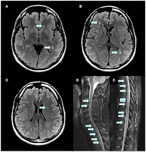 Frontiers Presymptomatic Diagnosis With Mri And Adequate Treatment