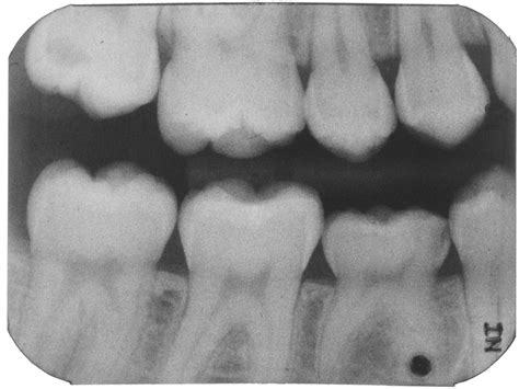 Occlusal Augmentation Of An Ankylosed Primary Second Molar With No