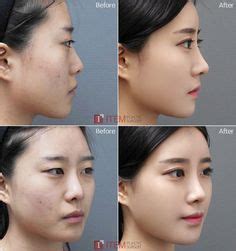 Because, from her younger photo and the latest one, her eyes still looked the same. Kim Tae Hee Plastic Surgery Before and After Eyelid ...
