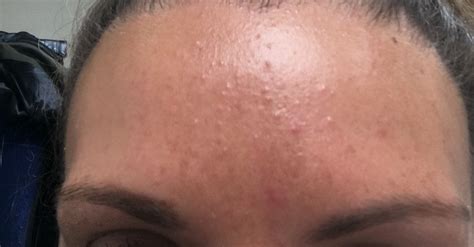 Small Colourless Bumps On My Forehead General Acne Discussion By