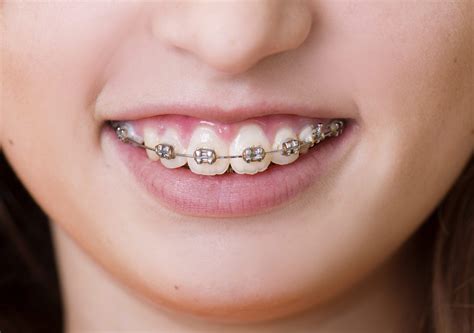 The Evolution Of Orthodontics And Braces Best Smiles