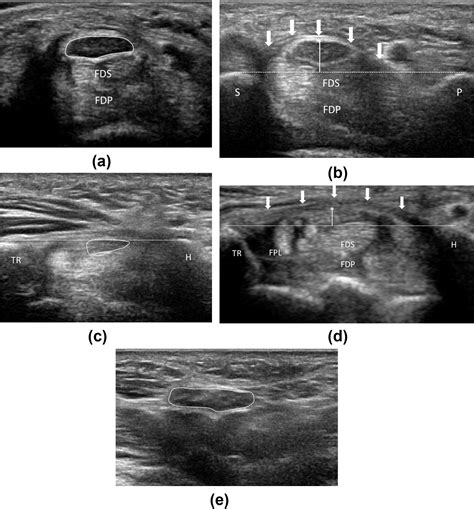 Ultrasound Carpal Tunnel Syndrome Additional Criteria For Diagnosis