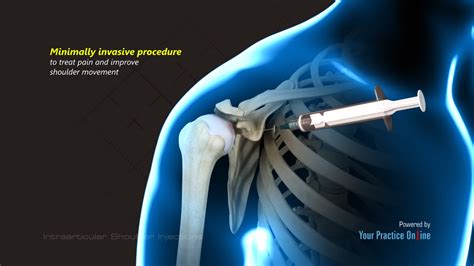 Intraarticular Shoulder Injections Video Medical Video Library