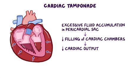 Cardiac Tamponade Clinical Sciences Osmosis Video Library
