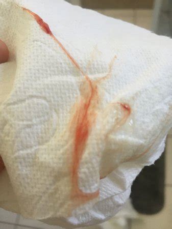 Mucus plug is a gelatinous substance that blocks the opening of the cervix. How much blood in bloody show? Warning - pics! - BabyCenter