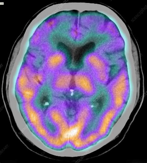 Depression Spect Ct Scan Stock Image C0393579 Science Photo Library