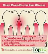 At Home Gum Disease Treatment Photos