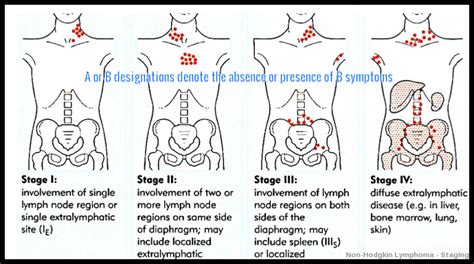 Non Hodgkin Lymphoma Ask Hematologist Understand Hematology