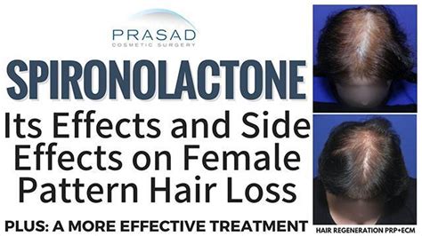 Effects Of Spironolactone On Female Pattern Hair Loss And On The