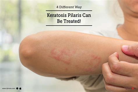 Different Way Keratosis Pilaris Can Be Treated By Dr Purvi C Shah