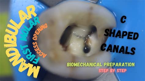 Access Opening In Mandibular First Molar With Mesial Caries C Shaped