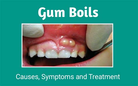 How Do I Treat A Gum Boil Gum Boils What You Need To Know How To