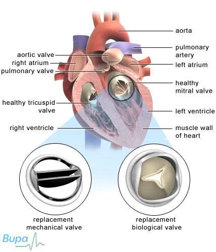 Cardiac Valve Replacement