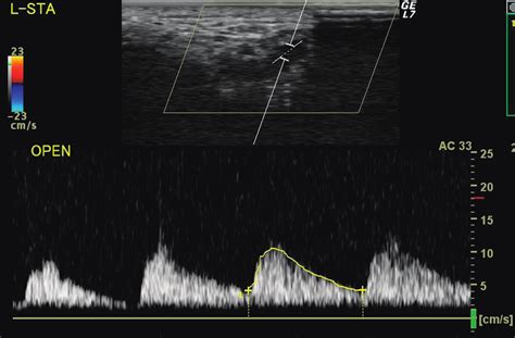 The Representative Findings Of Left Superficial Temporal Artery Download Scientific Diagram