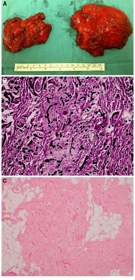 Macroscopic View Of The Resected Specimen Elastofibromas Are Dermal